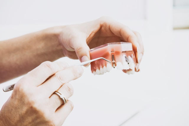 Exploring the Aesthetic and Functional Advantages of Dental Implants